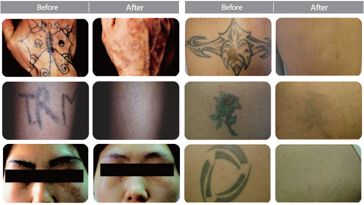 TATTOO REMOVAL  DERMAPROGR